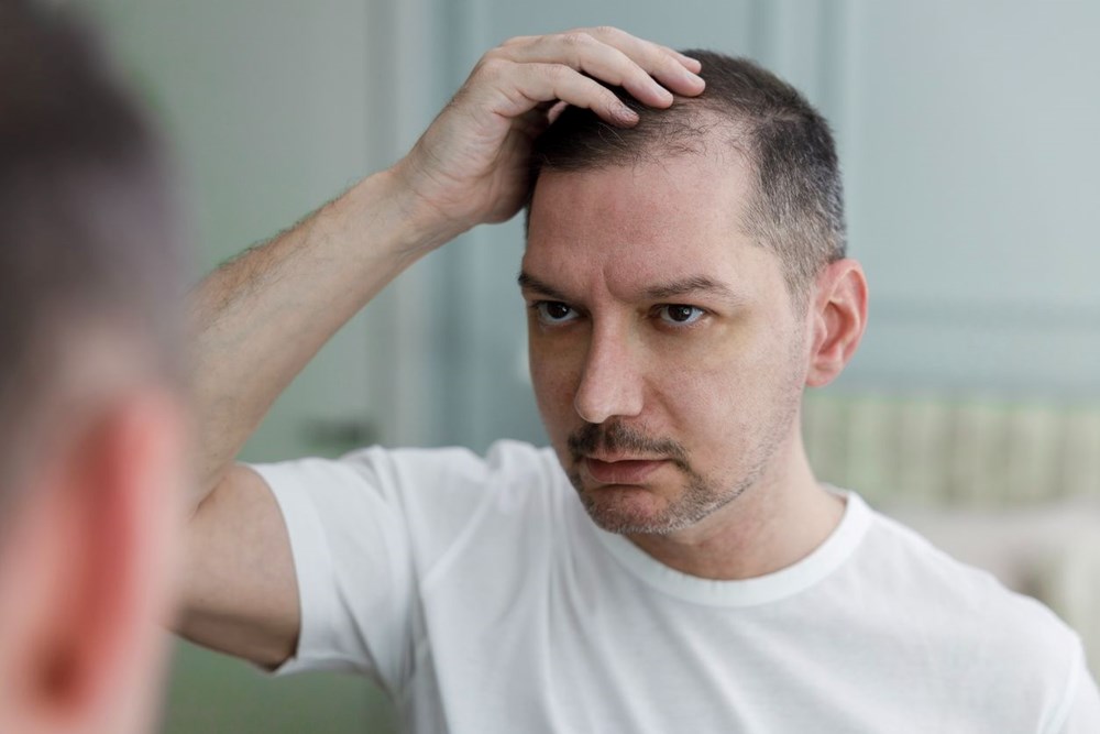 erkeklerde sac dokulmesinin 5 nedeni 1