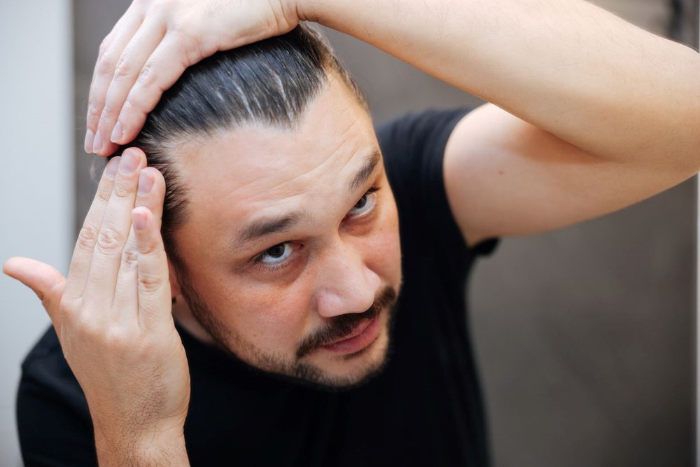 erkeklerde sac dokulmesinin 5 nedeni 2 X4z3hnYC